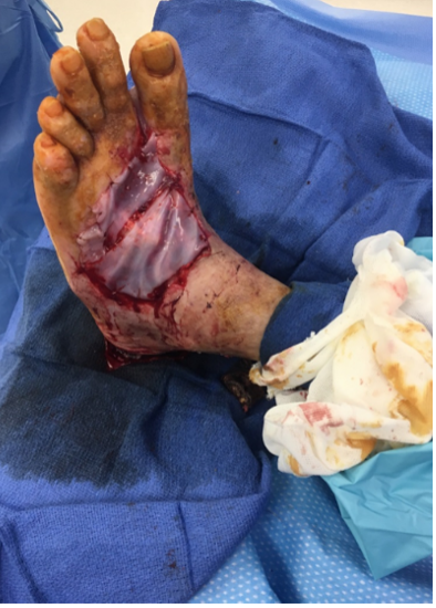 4 weeks after stravix tissue and reapplication
