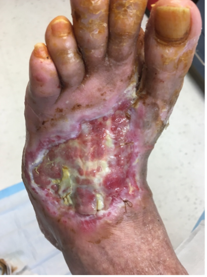6 weeks after stravix tissue 
