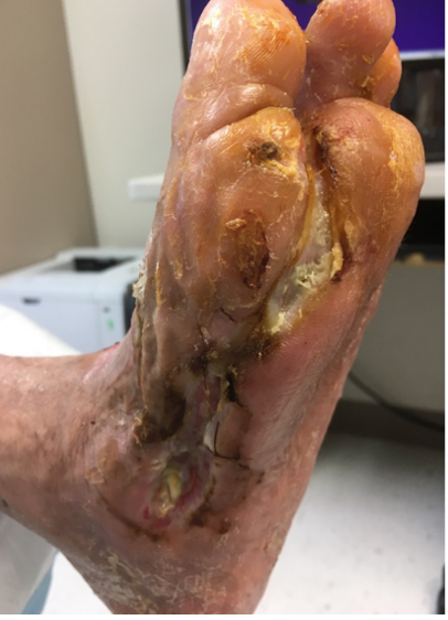 6 weeks after stravix tissue 