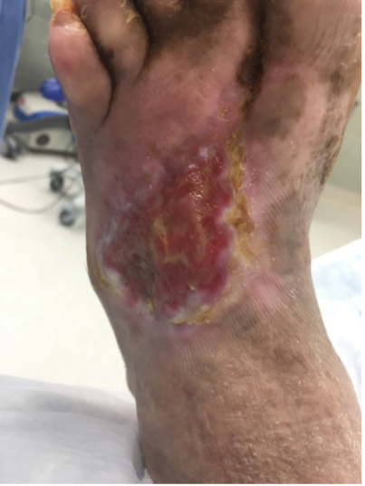 8 weeks after stravix tissue and reapplication