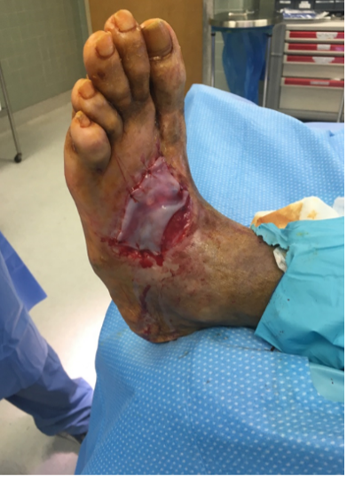 8 weeks after stravix tissue and reapplication
