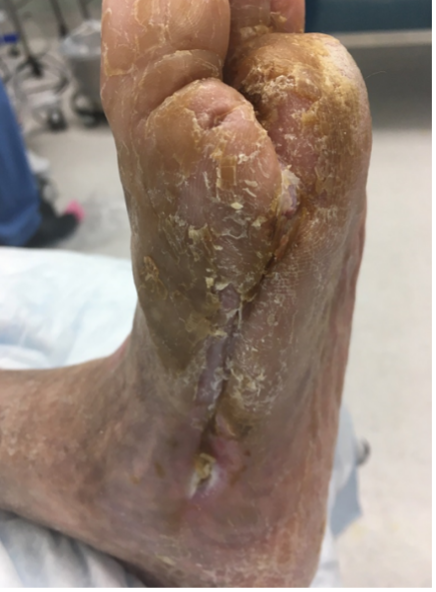 12 weeks after stravix tissue