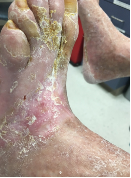 12 weeks after stravix tissue