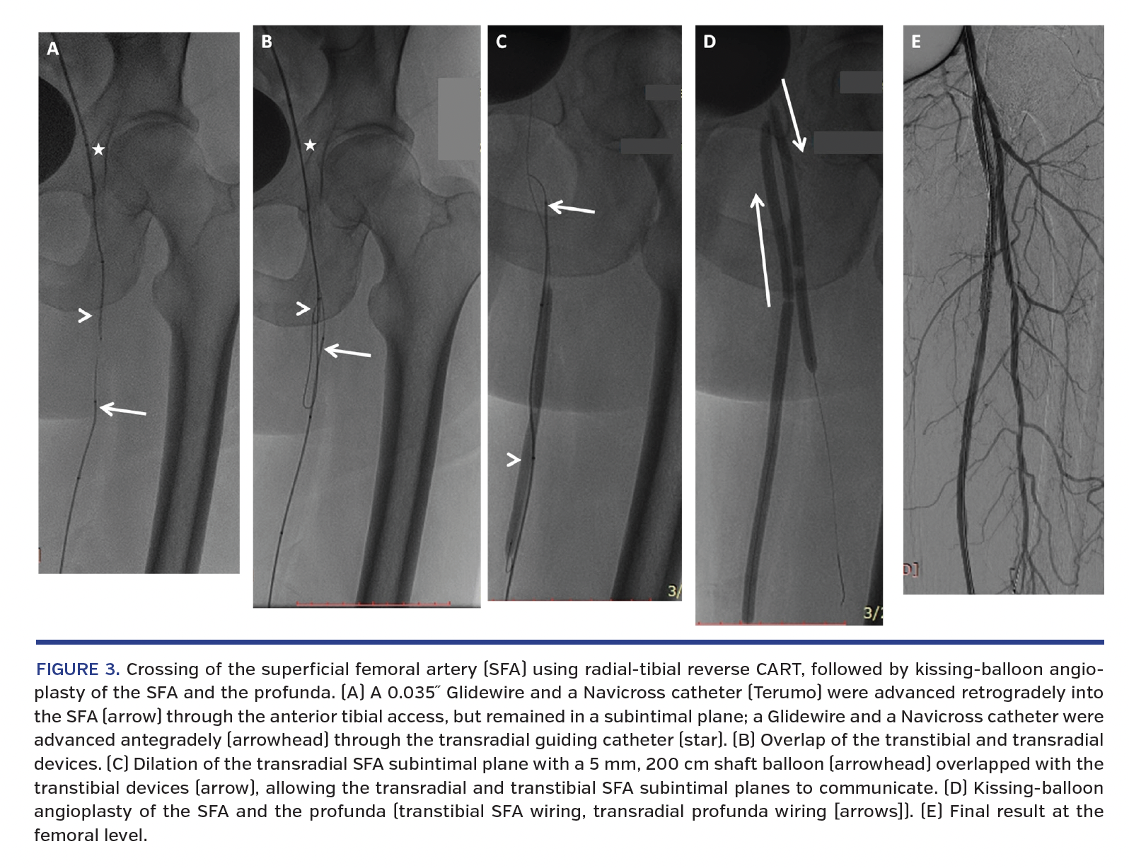Crossing of the superficial femoral artery (SFA) using radial-tibial reverse CART