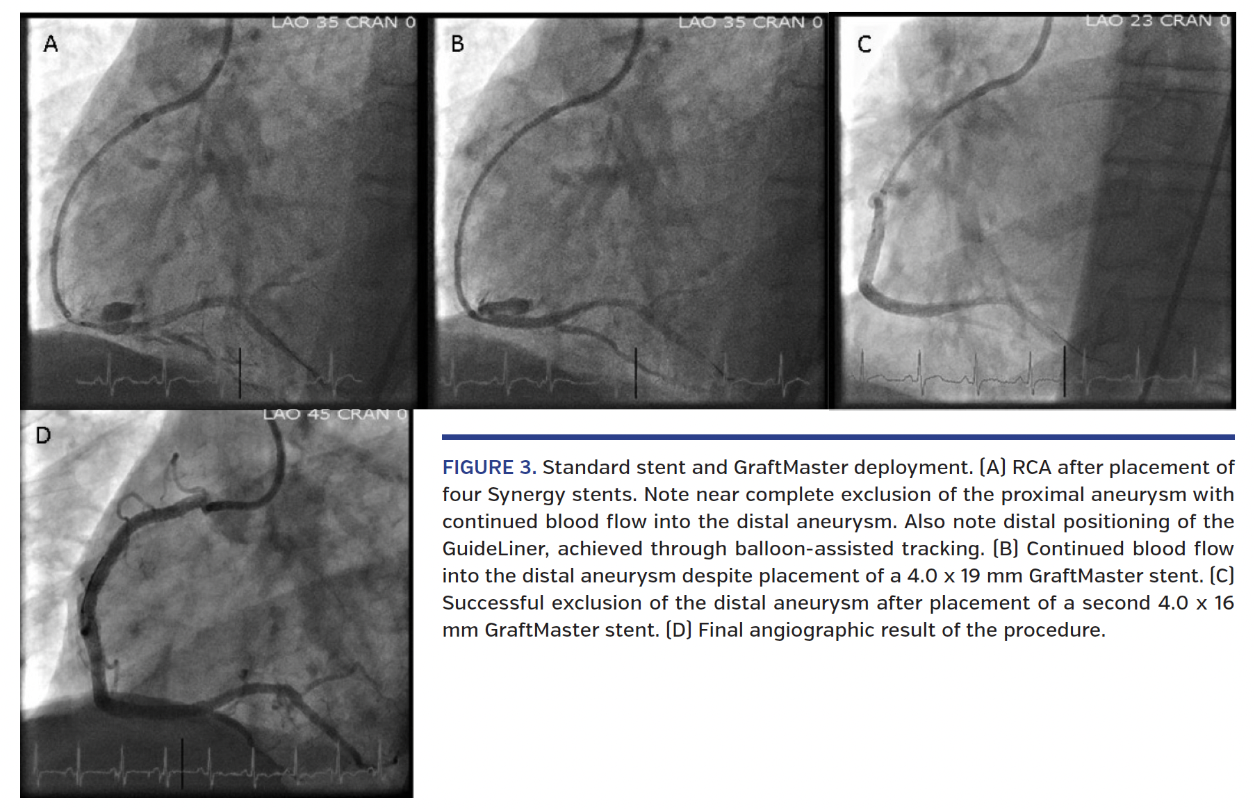 FIGURE 3. Standard stent and GraftMaster deployment. (A) RCA after placement of four Synergy stents. Note near complete exclusion of the proximal aneurysm with continued blood flow into the distal aneurysm. Also note distal positioning of the GuideLiner, achieved through balloon-assisted tracking. (B) Continued blood flow into the distal aneurysm despite placement of a 4.0 x 19 mm GraftMaster stent. (C) Successful exclusion of the distal aneurysm after placement of a second 4.0 x 16 mm GraftMaster stent. (D) Final angiographic result of the procedure.