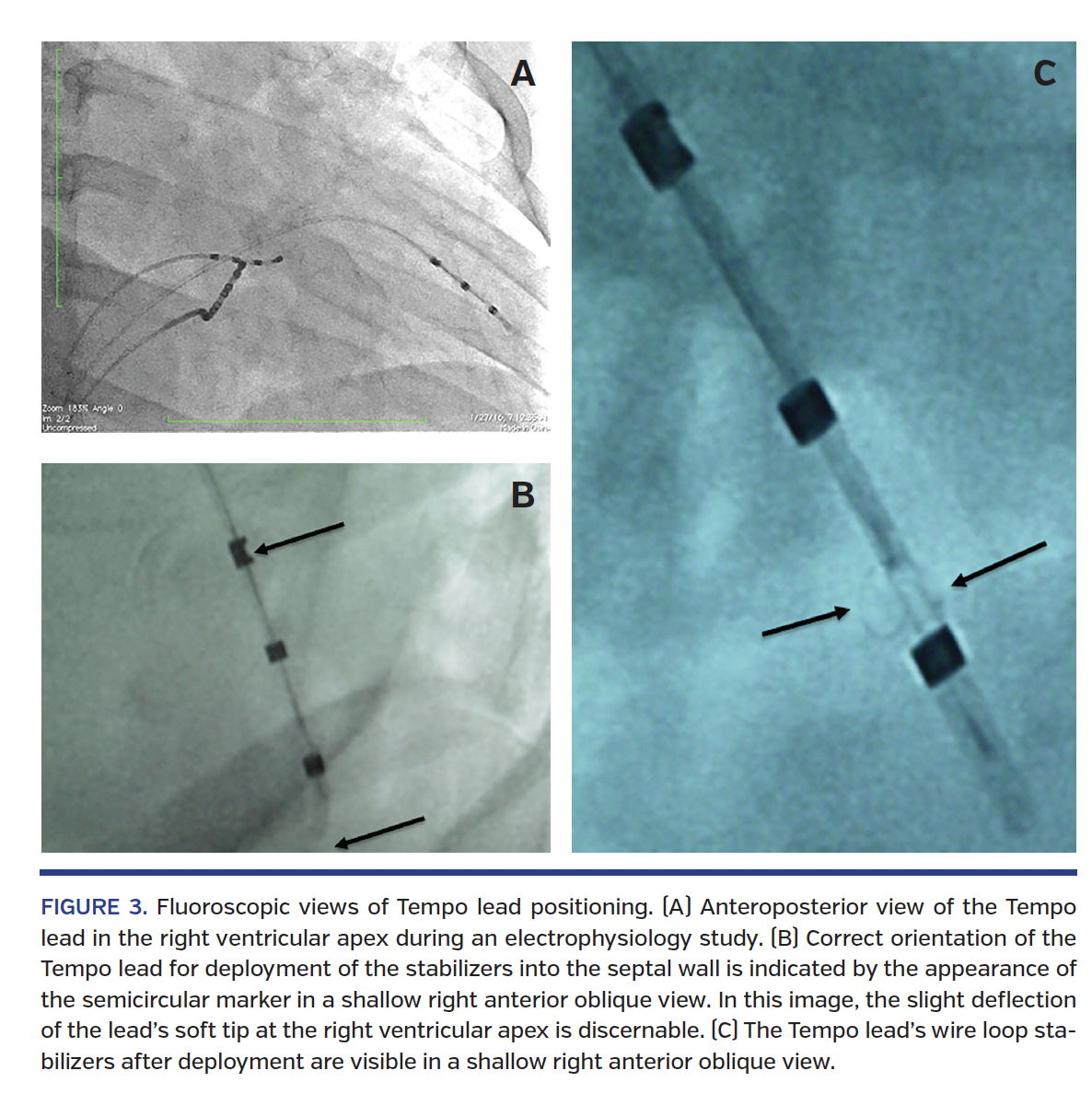 FIGURE 3. Fluoroscopic views of Tempo lead positioning. (A) Anteroposterior view of the Tempo lead in the right ventricular apex during an electrophysiology study. (B) Correct orientation of the Tempo lead for deployment of the stabilizers into the septal wall is indicated by the appearance of the semicircular marker in a shallow right anterior oblique view. In this image, the slight deflection of the lead’s soft tip at the right ventricular apex is discernable. (C) The Tempo lead’s wire loop stabilizers after deployment are visible in a shallow right anterior oblique view.