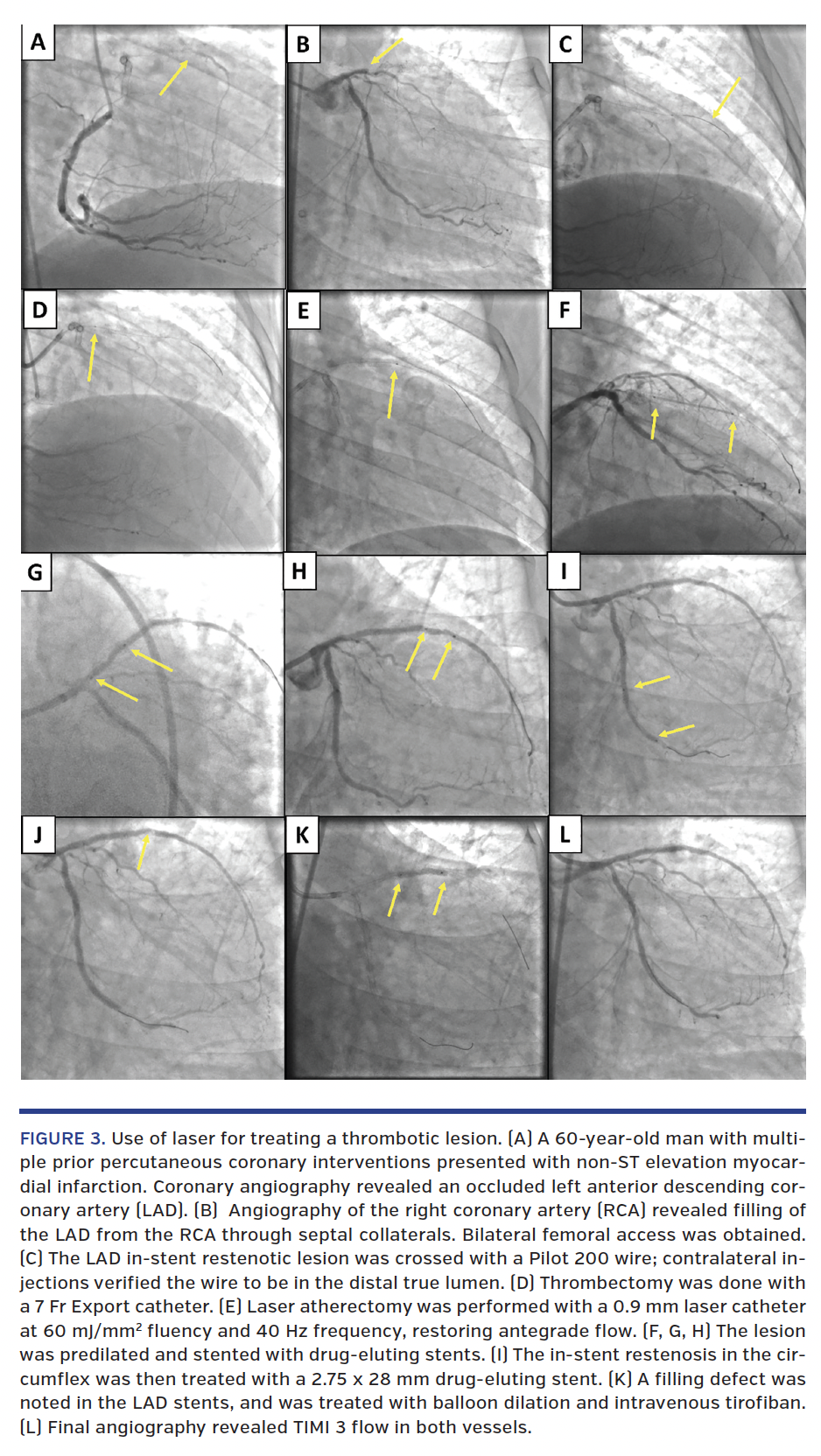 FIGURE 3. Use of laser for treating a thrombotic lesion.
