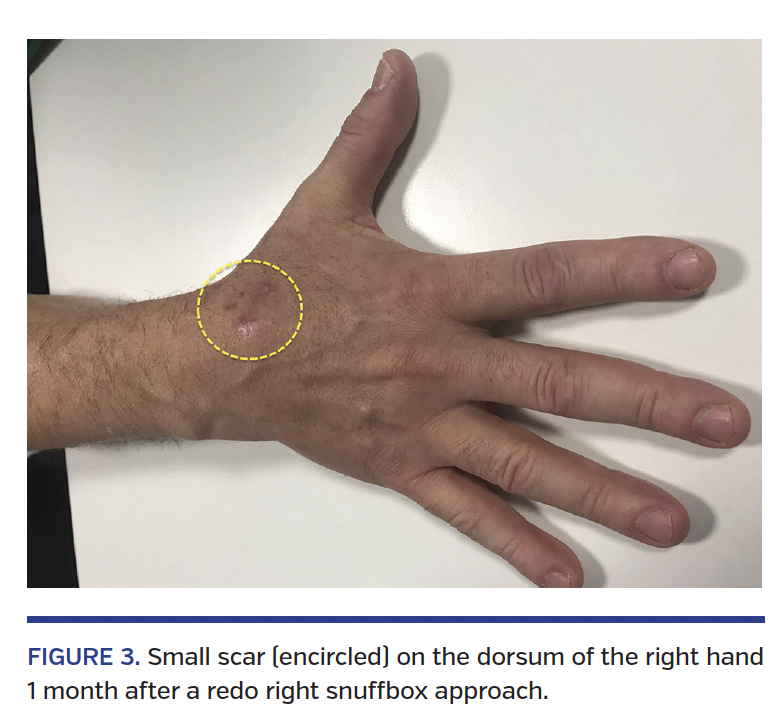 FIGURE 3. Small scar (encircled) on the dorsum of the right hand 1 month after a redo right snuffbox approach.
