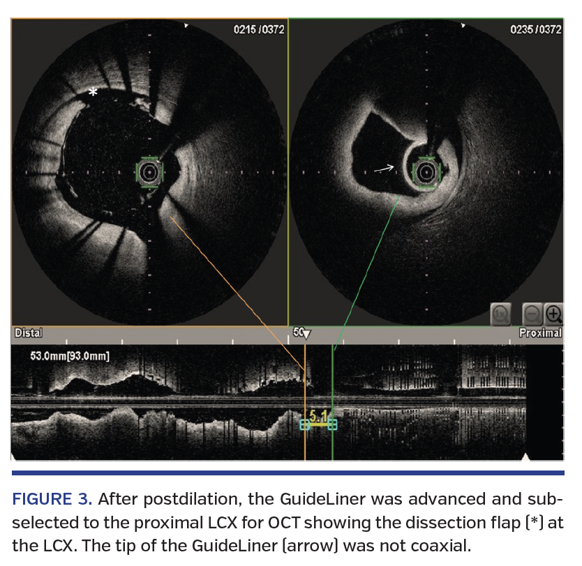 FIGURE 3. After postdilation, the GuideLiner was advanced and subselected to the proximal LCX for OCT showing the dissection flap (*) at the LCX. The tip of the GuideLiner (arrow) was not coaxial.