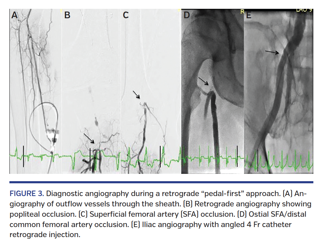 FIGURE 3. Diagnostic angiography during a retrograde “pedal-first” approach. (A) Angiography of outflow vessels through the sheath. (B) Retrograde angiography showing popliteal occlusion. (C) Superficial femoral artery (SFA) occlusion. (D) Ostial SFA/distal common femoral artery occlusion. (E) Iliac angiography with angled 4 Fr catheter retrograde injection.