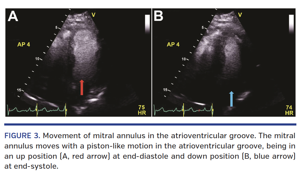 FIGURE 3. Movement of mitral annulus in the atrioventricular groove. The mitral annulus moves with a piston-like motion in the atrioventricular groove, being in an up position (A, red arrow) at end-diastole and down position (B, blue arrow) at end-systole.