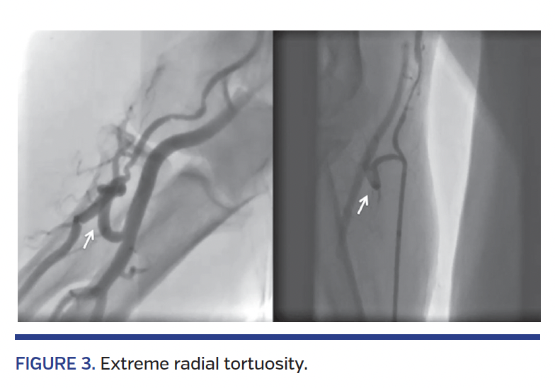FIGURE 3. Extreme radial tortuosity.