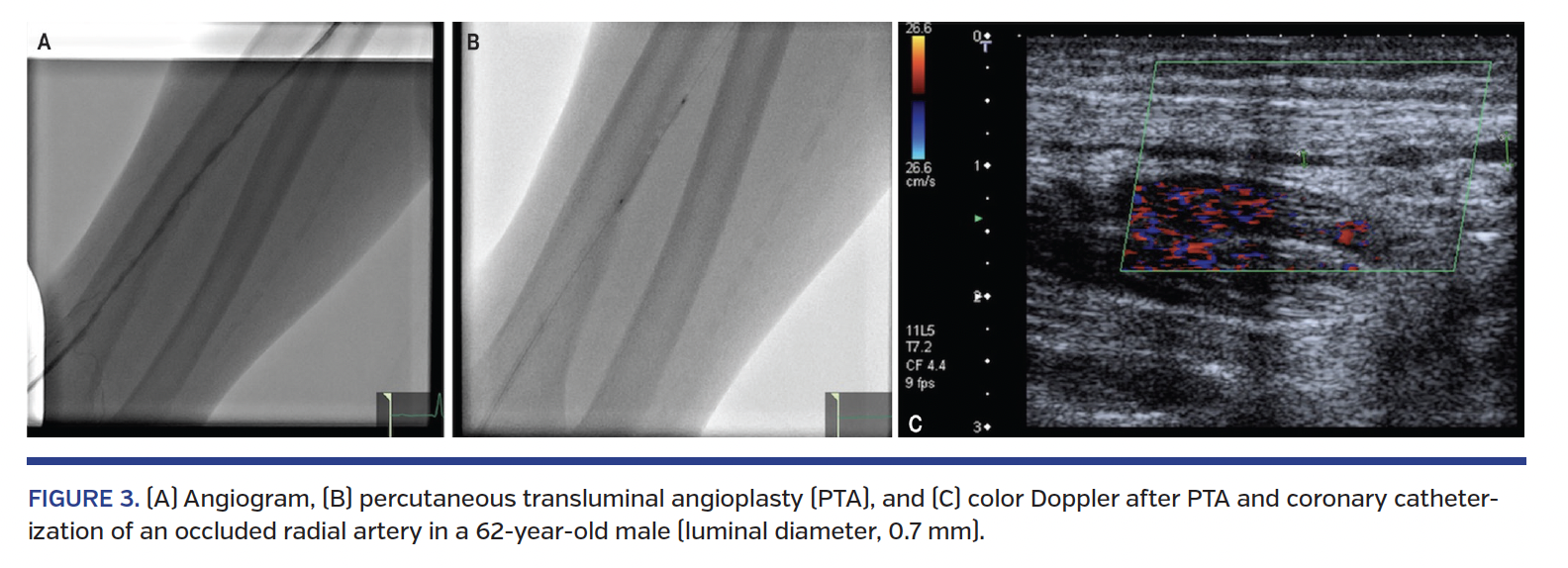 FIGURE 3. (A) Angiogram, (B) percutaneous transluminal angioplasty (PTA), and (C) color Doppler after PTA and coronary catheterization of an occluded radial artery in a 62-year-old male (luminal diameter, 0.7 mm).