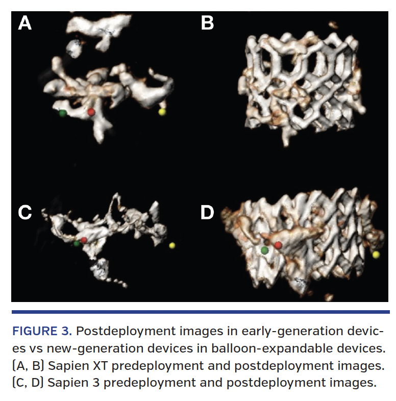 FIGURE 2. Region of the aortic valvular complex. Figure shows an example of severe left ventricular outflow tract (LVOT) calcification. The LVOT region is from the annulus to 4 mm inferior to it. (A) Cross-sectional area of annulus level. (B) Cross-sectional area of LVOT level.