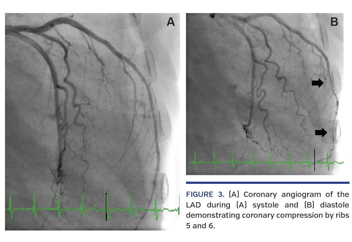 FIGURE 3. (A) Coronary angiogram of the LAD during (A) systole and (B) diastole demonstrating coronary compression by ribs 5 and 6.