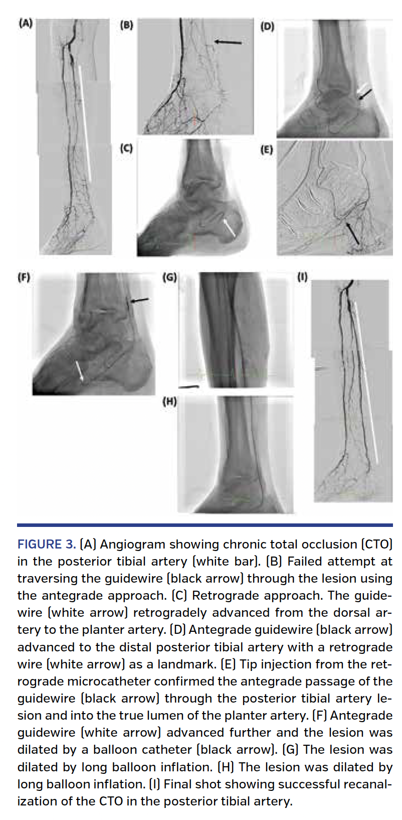 Long-Term Result s of a Retrograde Approach