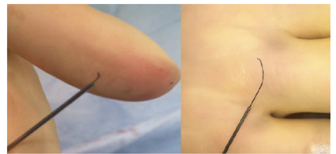 Figure 3. Wire bends are essential to travel vessels and cross lesions. Sharp bends are needed at calcific and chronic total occlusion stenosis, as well as short bends near the wire tip to preserve crossing force.