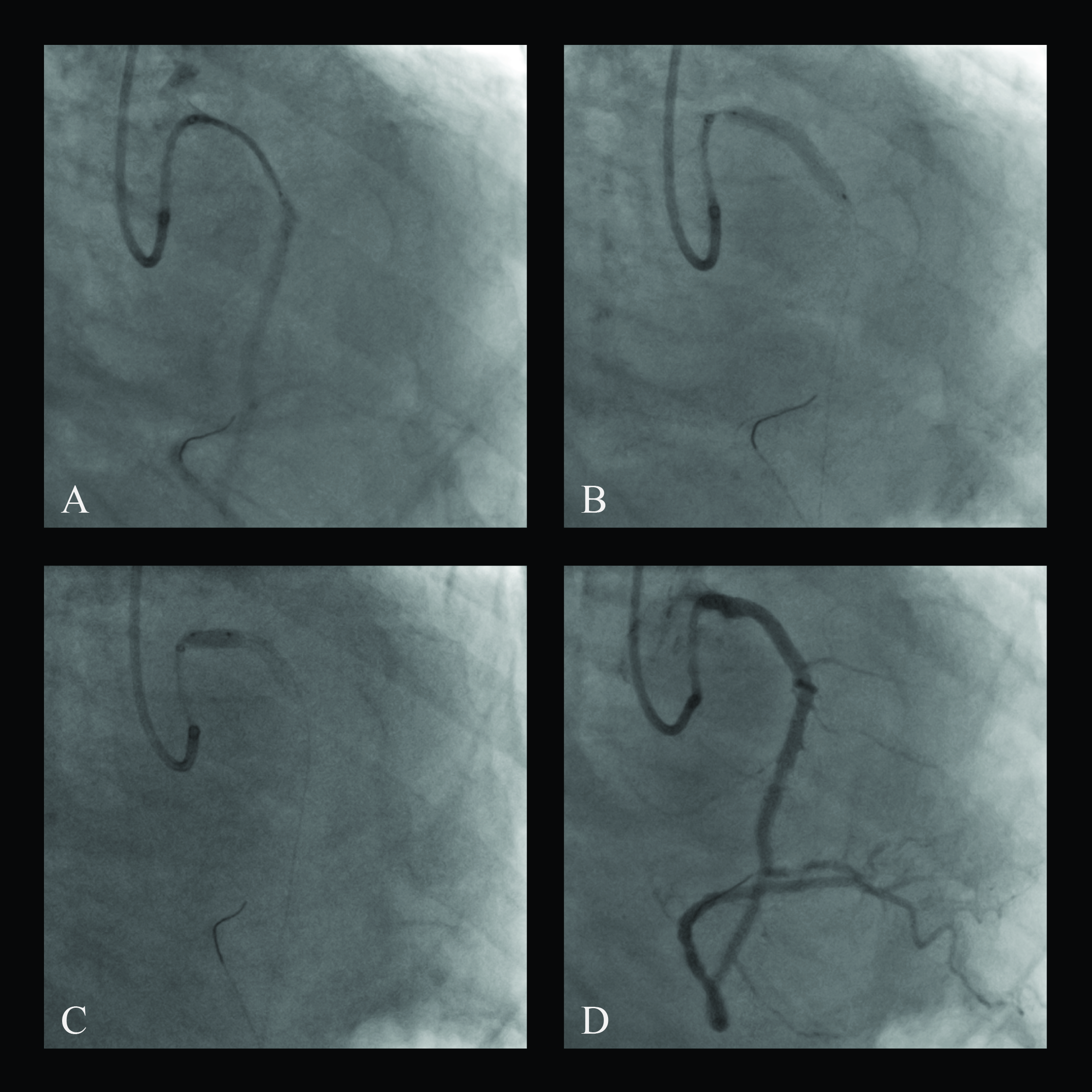 Figure 3. Percutaneous coronary intervention