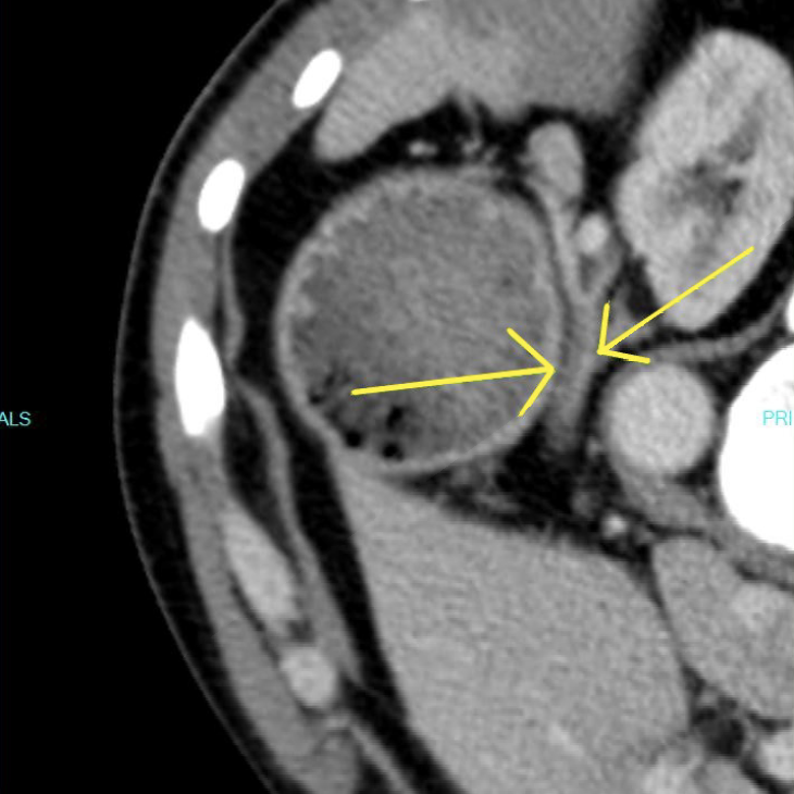 Figure 3. Arrows showing opacified false lumen extending along the splenic artery toward the splenic hilum.
