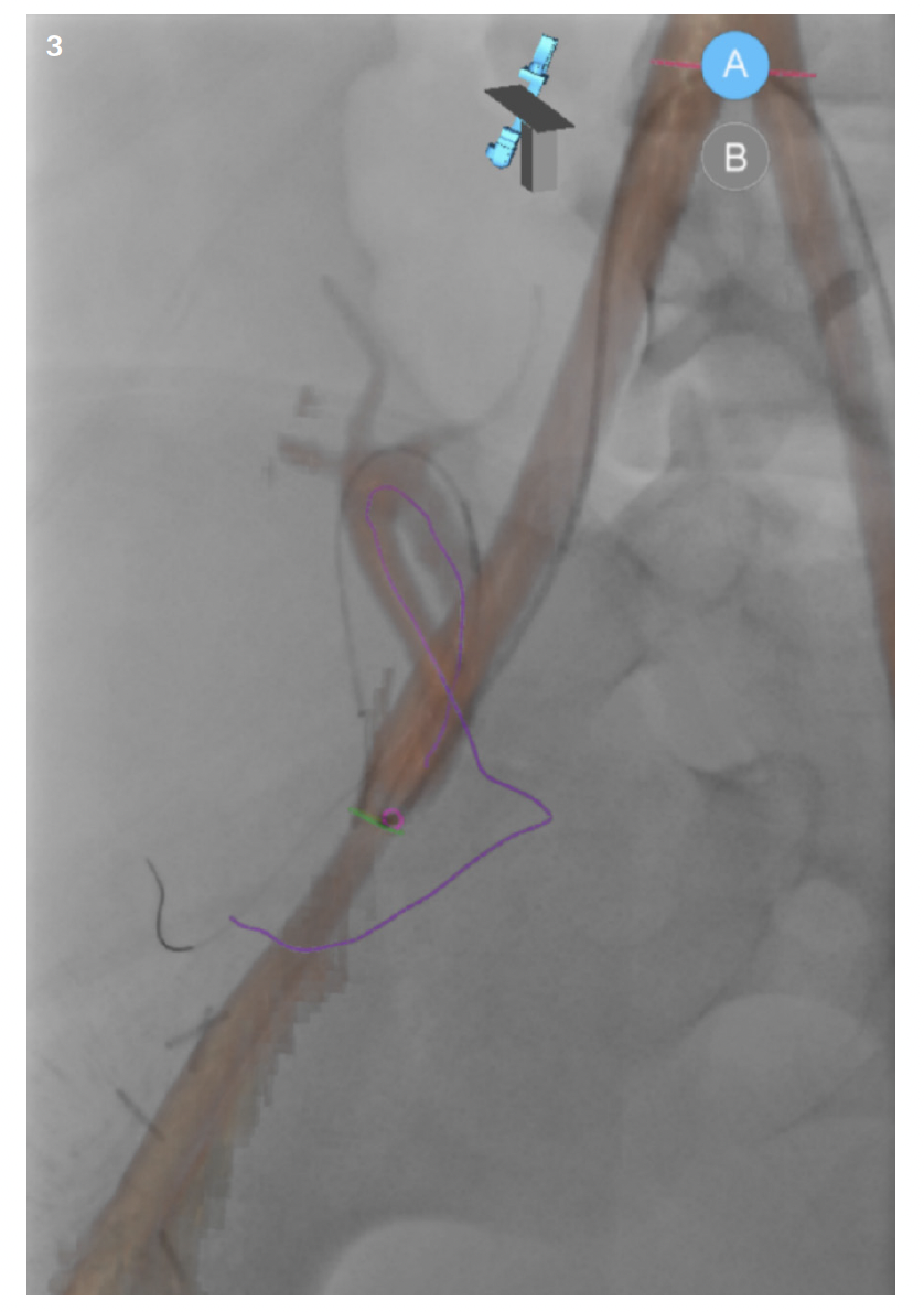 Figures 3 and 4. An example of an advanced software is a tool called syngo embolization guidance, combined with fusion imaging, which automatically identifies and tracks blood vessels that feed specific anatomical regions. This tool is used with syngo DynaCT and is useful for confirmation feeder vessels which might be difficult to identify on 2D imaging alone. It also generates a vascular map, which can be overlaid on live 2D fluoro and used for guiding devices to the appropriate location. The vessel map generated by this tool is indicated by the purple/pink line in the image.
