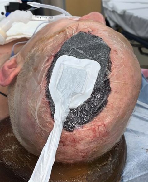 Placement of NPWT dressing, day 10