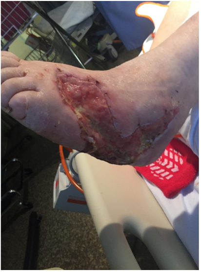 2 weeks after stravix tissue
