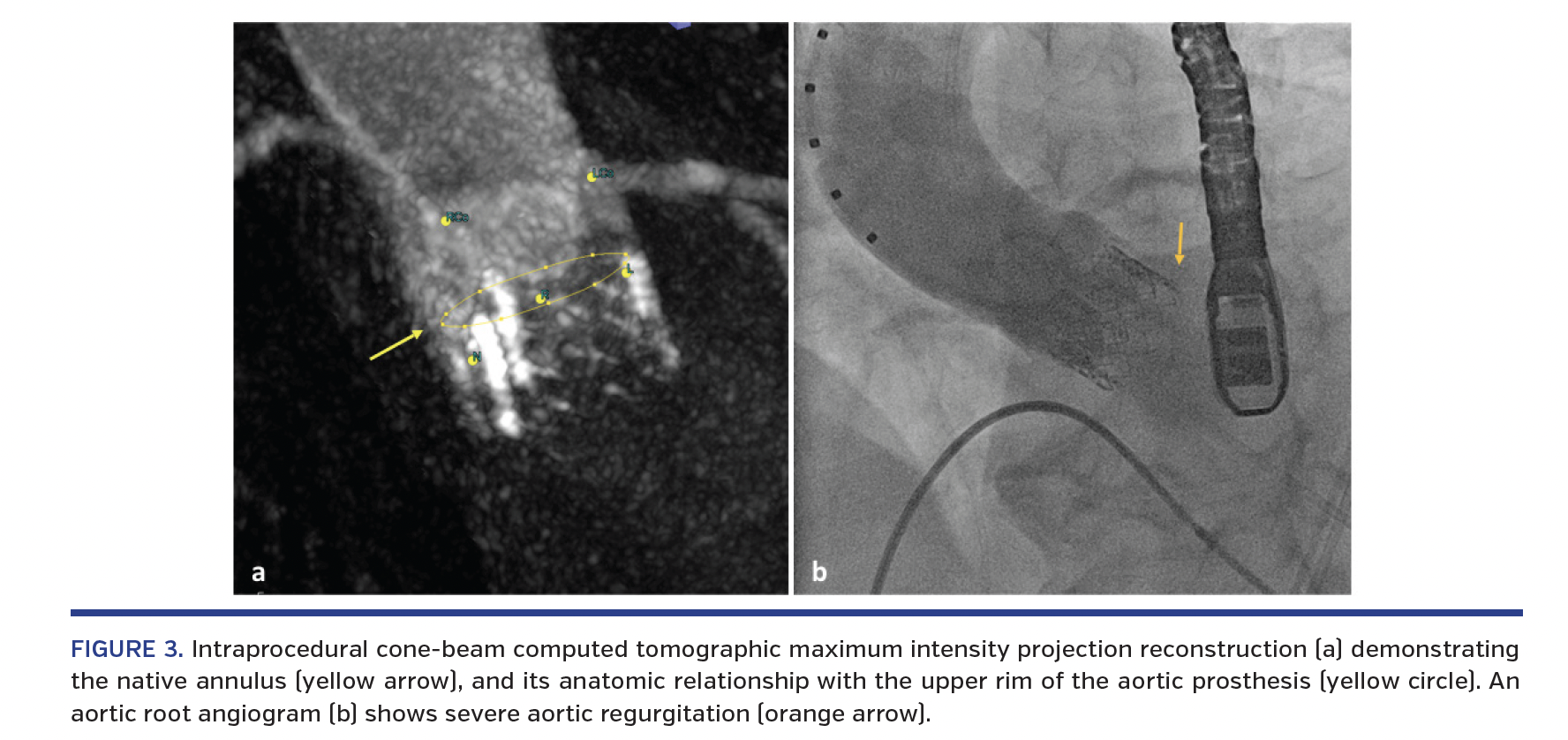 FIGURE 3. Intraprocedural cone-beam computed tomographic maximum intensity projection reconstruction (a) demonstrating the native annulus (yellow arrow), and its anatomic relationship with the upper rim of the aortic prosthesis (yellow circle). An aortic root angiogram (b) shows severe aortic regurgitation (orange arrow).
