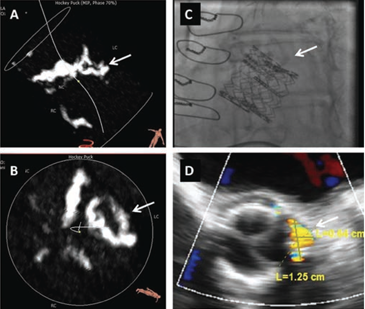 FIGURE 3. Transcatheter valve in transcatheter valve (TV-inTV) for paravalvular leak (PVL) caused by bulky calcium. (A, B) A preprocedural computed tomography revealed bulky calcium at the left coronary cusp corresponding to the PVL site. (C) TV-in-TV procedure was performed. The second valve (more ventricular) seemed to be slightly deformed at the calcification site; the position might also have been too ventricular for the device skirt to cover the PVL. (D) A follow-up transesophageal echocardiogram after TV-in-TV still showed the PVL (arrows indicate the location of calcification).