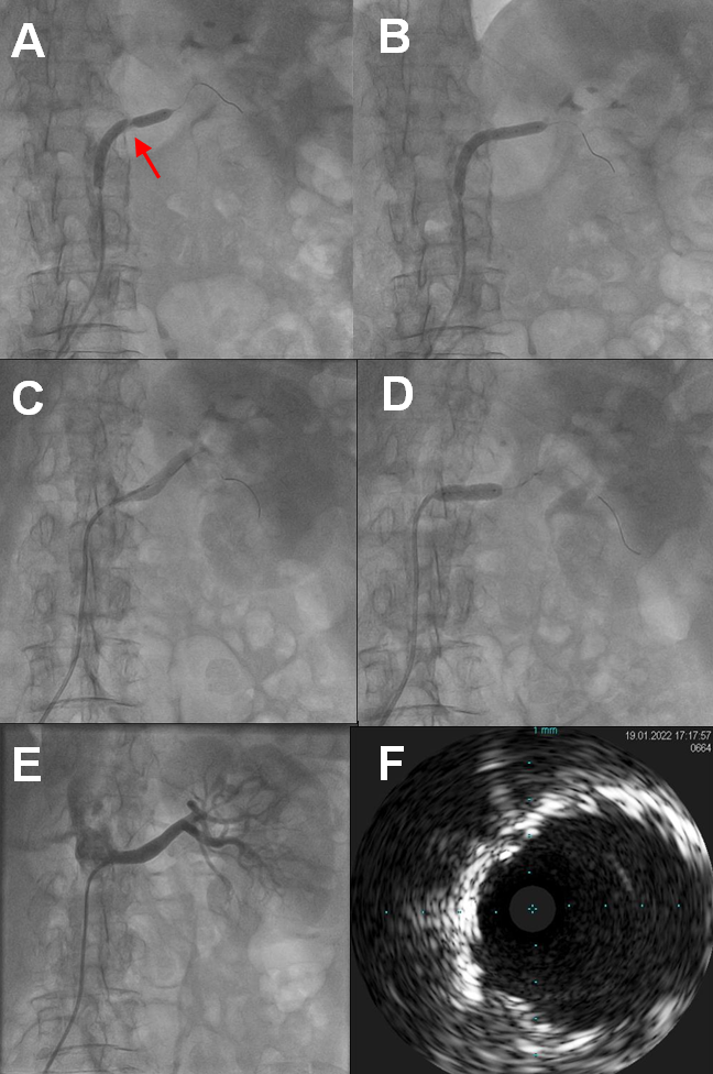 Figure 3.  Renal artery intervention