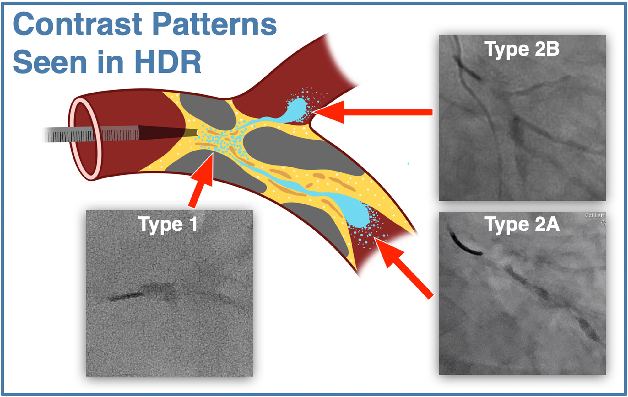 Figure 4. Illustration of the contrast patterns seen in HDR