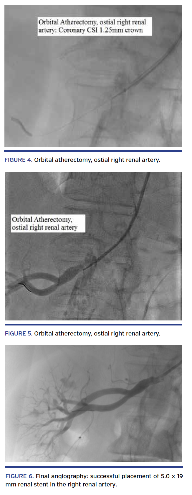 Orbital Atherectomy in the Renal Artery: A New Frontier for an Emerging Technology?
