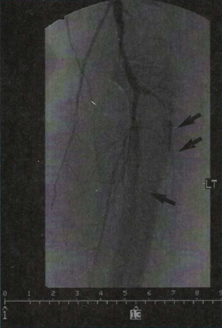 Figure 4. Lateral view. Observe the trifurcation of the left popliteal artery (Case 1). There are several areas of occlusion at different levels 48 hours after the first intervention had been on an intra-arterial urokinase drip.