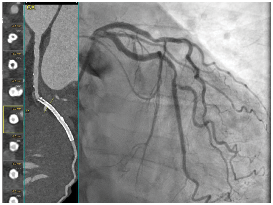 Figure 4. CCTA and invasive catheterization of the Cx.