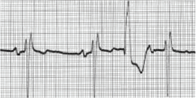 Figure 4. Interpolated PVC