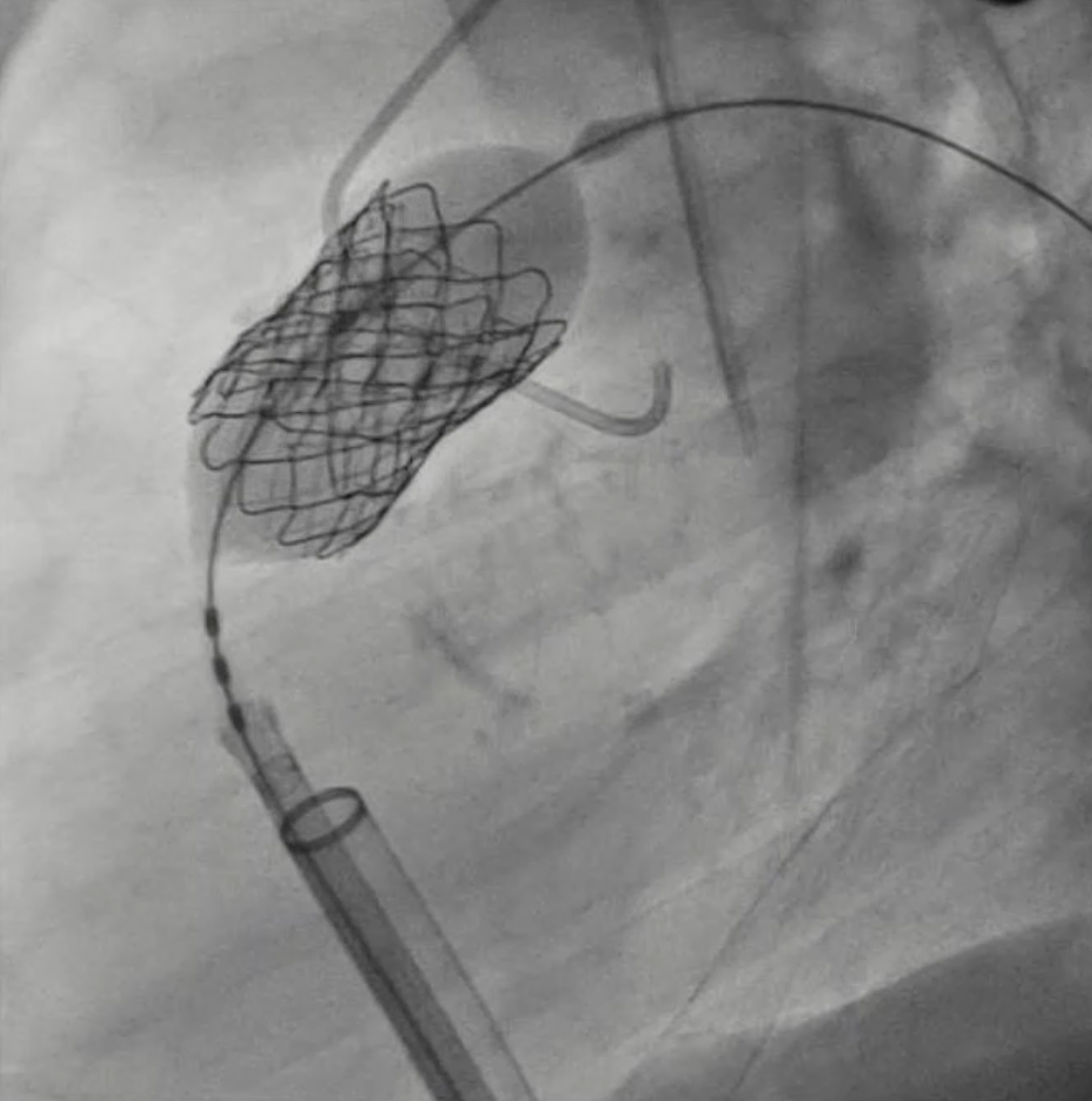 (Case 2) Figure 4. Valve deployment.
