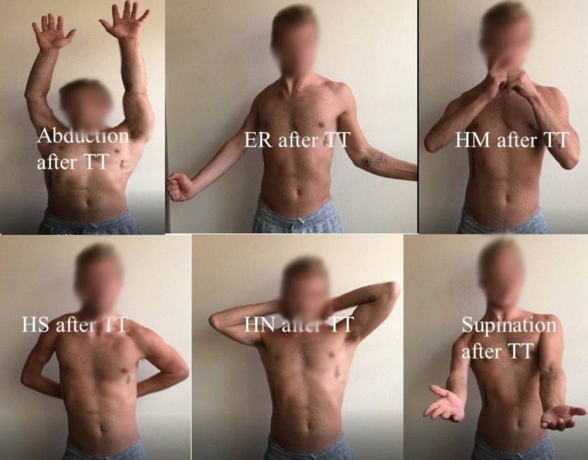 Figure 4. Modified Mallet movements of a 21-year-old man with OBPI after triangle tilt surgery.