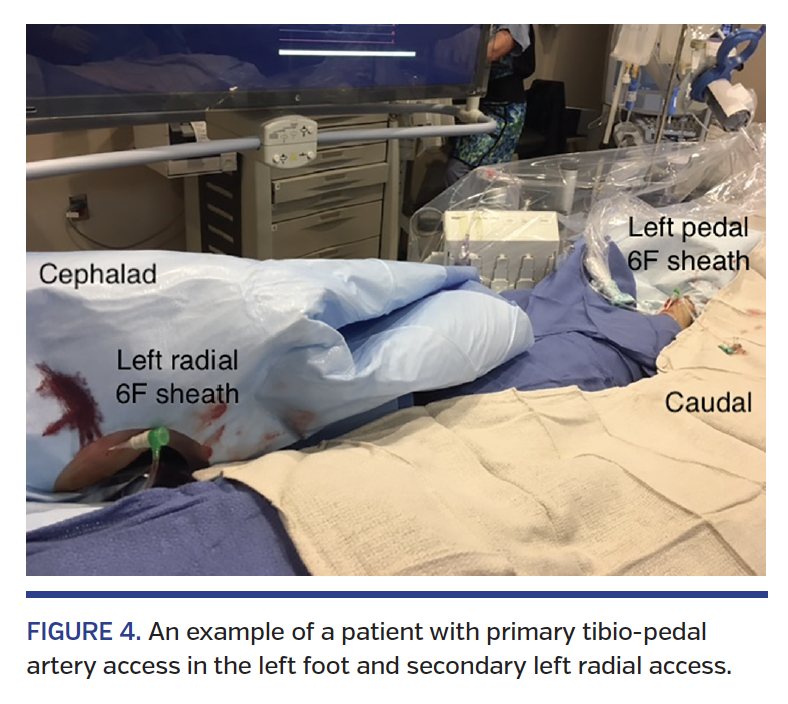 FIGURE 4. An example of a patient with primary tibio-pedal artery access in the left foot and secondary left radial access.