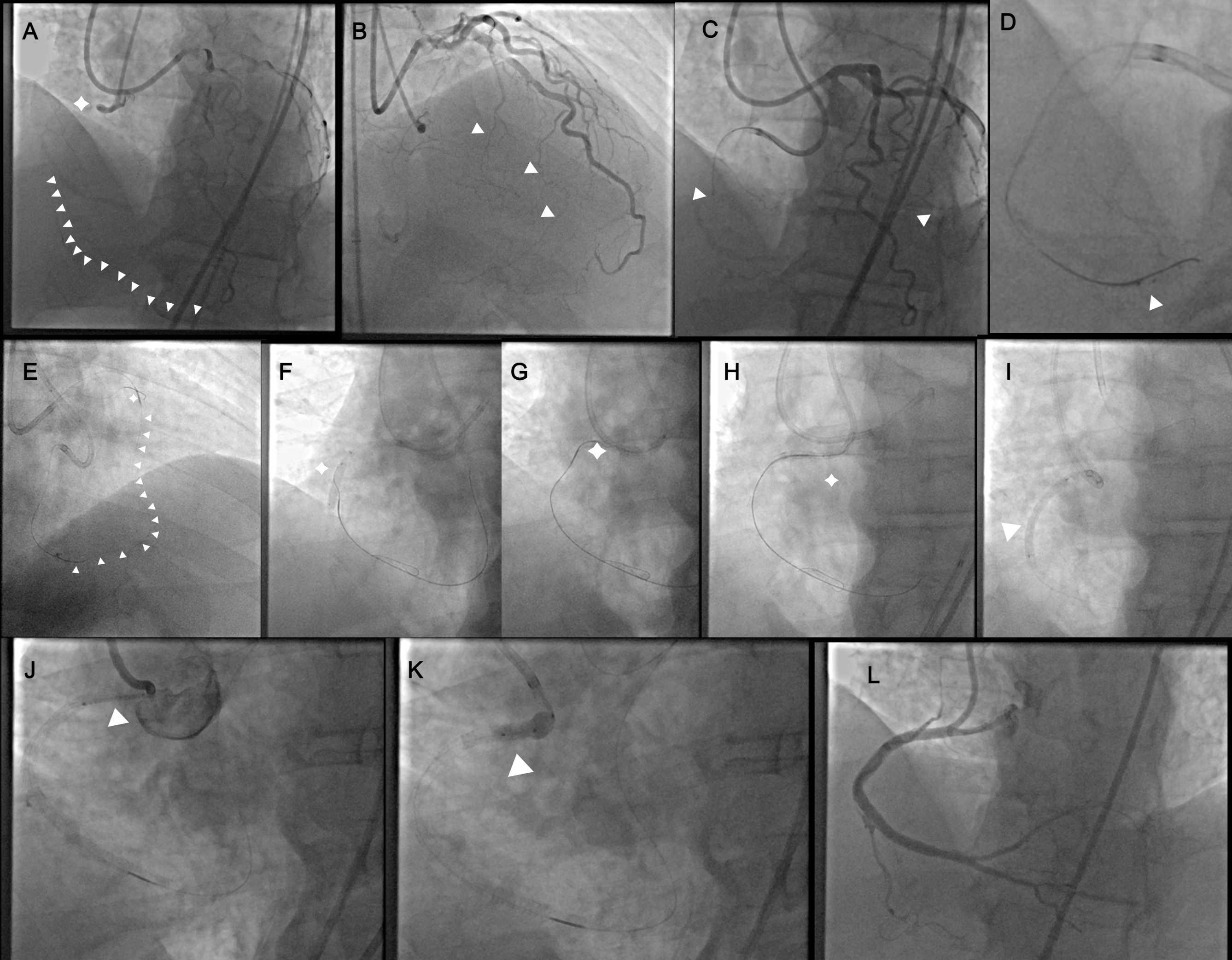 Figure 4. Right coronary artery 