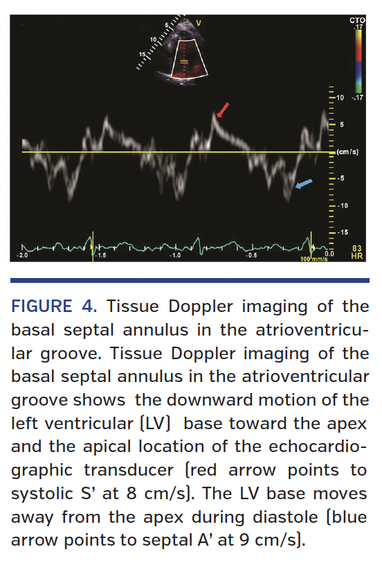 FIGURE 4. Tissue Doppler imaging of the basal septal annulus in the atrioventricular groove.
