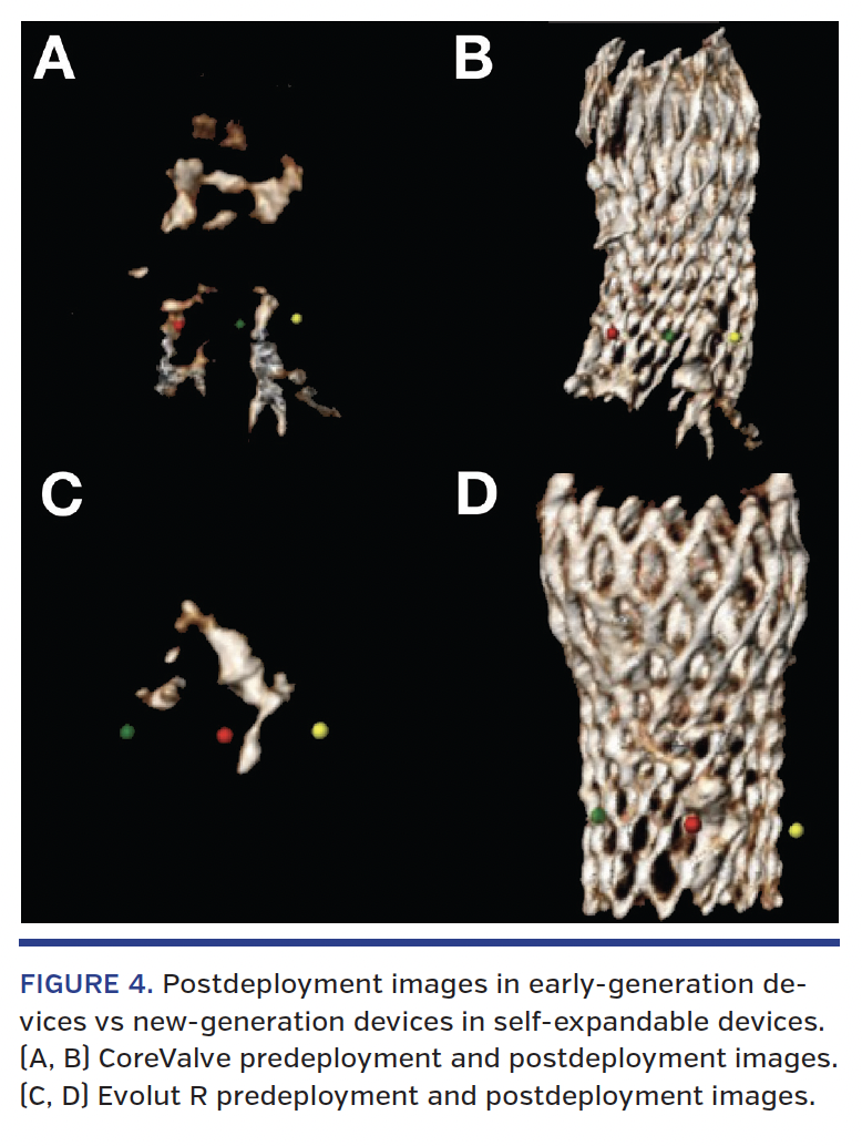 FIGURE 4. Postdeployment images in early-generation devices vs new-generation devices in self-expandable devices. (A, B) CoreValve predeployment and postdeployment images. (C, D) Evolut R predeployment and postdeployment images.