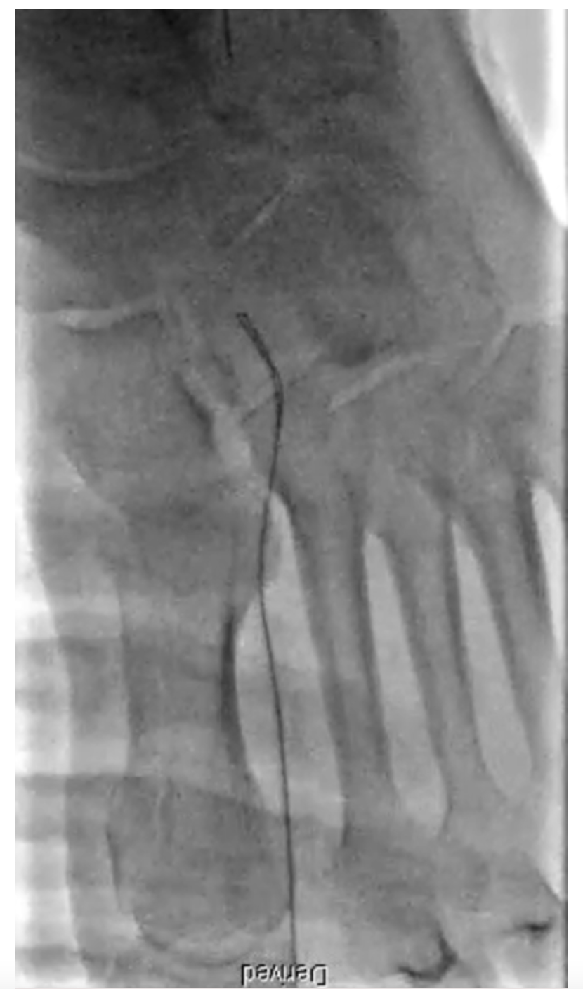 Figure 4. Distal transmetatarsal access obtained as retrograde access. Angiographic views may be used to achieve access.