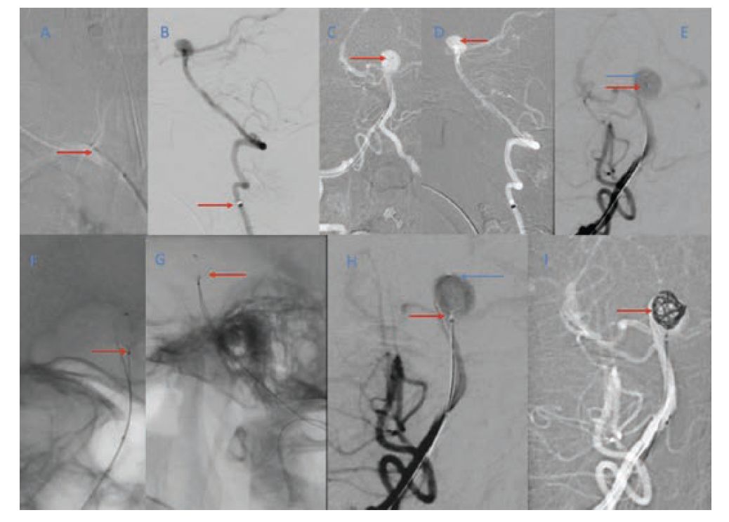 Figure 4. Therapeutic steps shown above are (A) Neuron MAX long sheath near the right vertebral origin. (B) Navien guiding catheter in the distal V2 segment with contrast angiogram showing the aneurysm in the basilar top. (C) and (D) Echelon-10 microcatheter used to cannulate the aneurysm with its tip in the aneurysm sac on both the anterior-posterior lateral planes. (E) A NeuroSlider 0.021" microcatheter is used to cannulate the aneurysm for delivery of the Neqstent. (F), (G), and (H) show a deployed Neqstent with jailing of the Echelon microcatheter just above the neck of the aneurysm, however, not detached. (I) After proper positioning of the microcatheter and Neqstent, coiling was started.