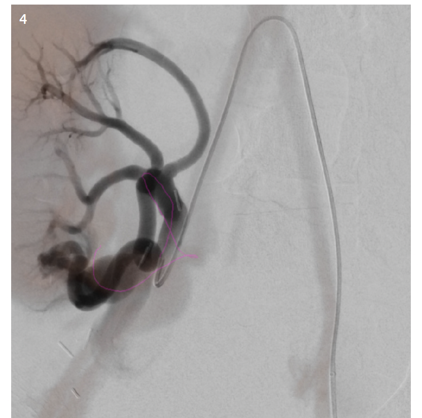 Figures 3 and 4. An example of an advanced software is a tool called syngo embolization guidance, combined with fusion imaging, which automatically identifies and tracks blood vessels that feed specific anatomical regions. This tool is used with syngo DynaCT and is useful for confirmation feeder vessels which might be difficult to identify on 2D imaging alone. It also generates a vascular map, which can be overlaid on live 2D fluoro and used for guiding devices to the appropriate location. The vessel map generated by this tool is indicated by the purple/pink line in the image.
