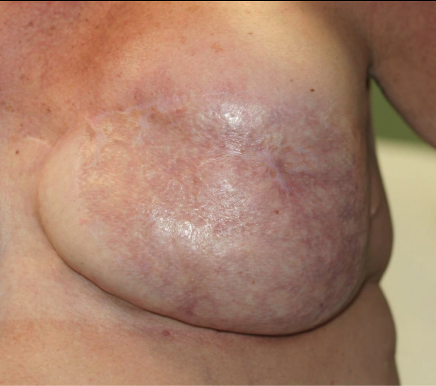 Complete take of split thickness skin graft
