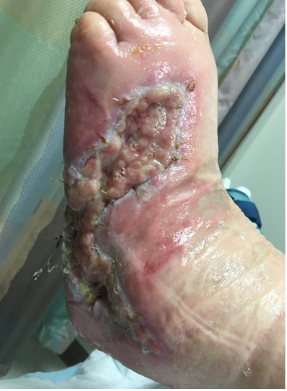 4 weeks after stravix tissue