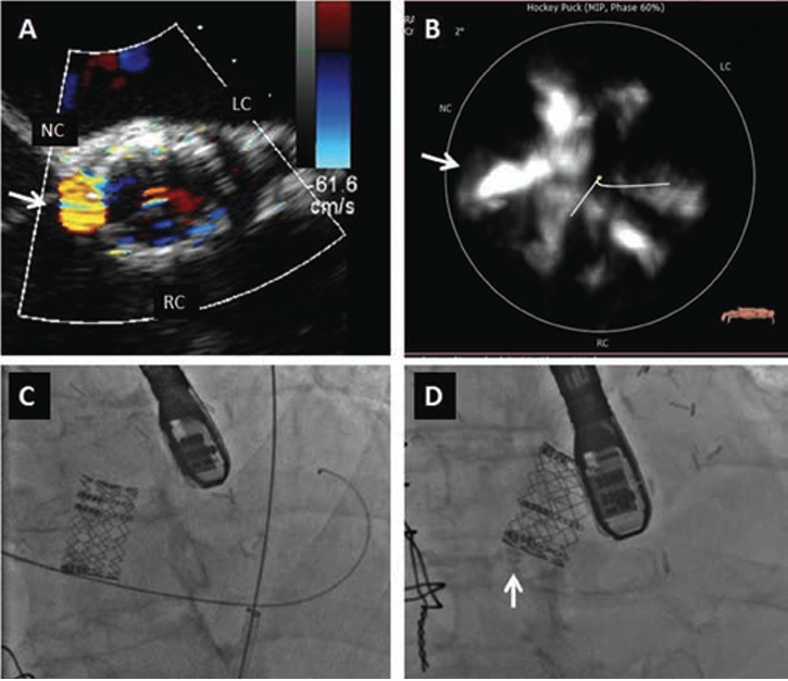 FIGURE 4. Example of unsuccessful percutaneous paravalvular leak (PVL) closure. (A) Transesophageal echocardiogram prior to percutaneous PVL closure. PVL is located adjacent to the non-coronary cusp (arrow). (B) Computed tomography prior to the transcatheter aortic valve replacement. The non-coronary cusp has severe calcification. (C) Percutaneous PVL closure. Although a wire crossed through the defect, there was difficulty advancing the delivery sheath. (D) Postprocedure fluoroscopy showed calcification at the site (arrow). RC = right coronary cusp; LC = left coronary cusp; NC = non-coronary cusp.