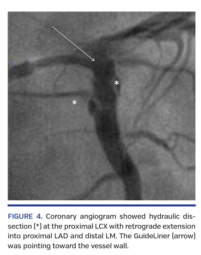 FIGURE 4. Coronary angiogram showed hydraulic dissection (*) at the proximal LCX with retrograde extension into proximal LAD and distal LM. The GuideLiner (arrow) was pointing toward the vessel wall.
