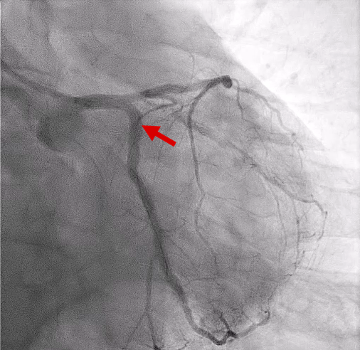 Figure 4. Final angiography