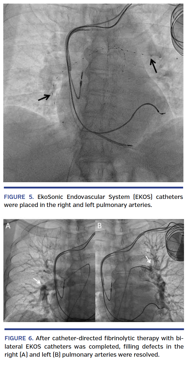 Fibrinolysis of Submassive Pulmonary Embolism