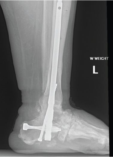 In this lateral radiograph in the staged protocol for midfoot Charcot neuroarthropathy, one can see the previous plantar osteotomy and the tibiotalocalcaneal fusion with the final internal fixation. Note the midfoot osteotomy is stable without the need for midfoot hardware.